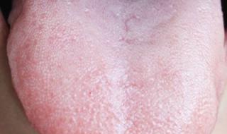 阳后舌头长厚白舌苔 阳后舌头长厚白舌苔